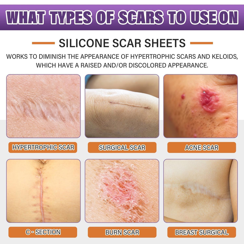 Silicone Scar Sheets