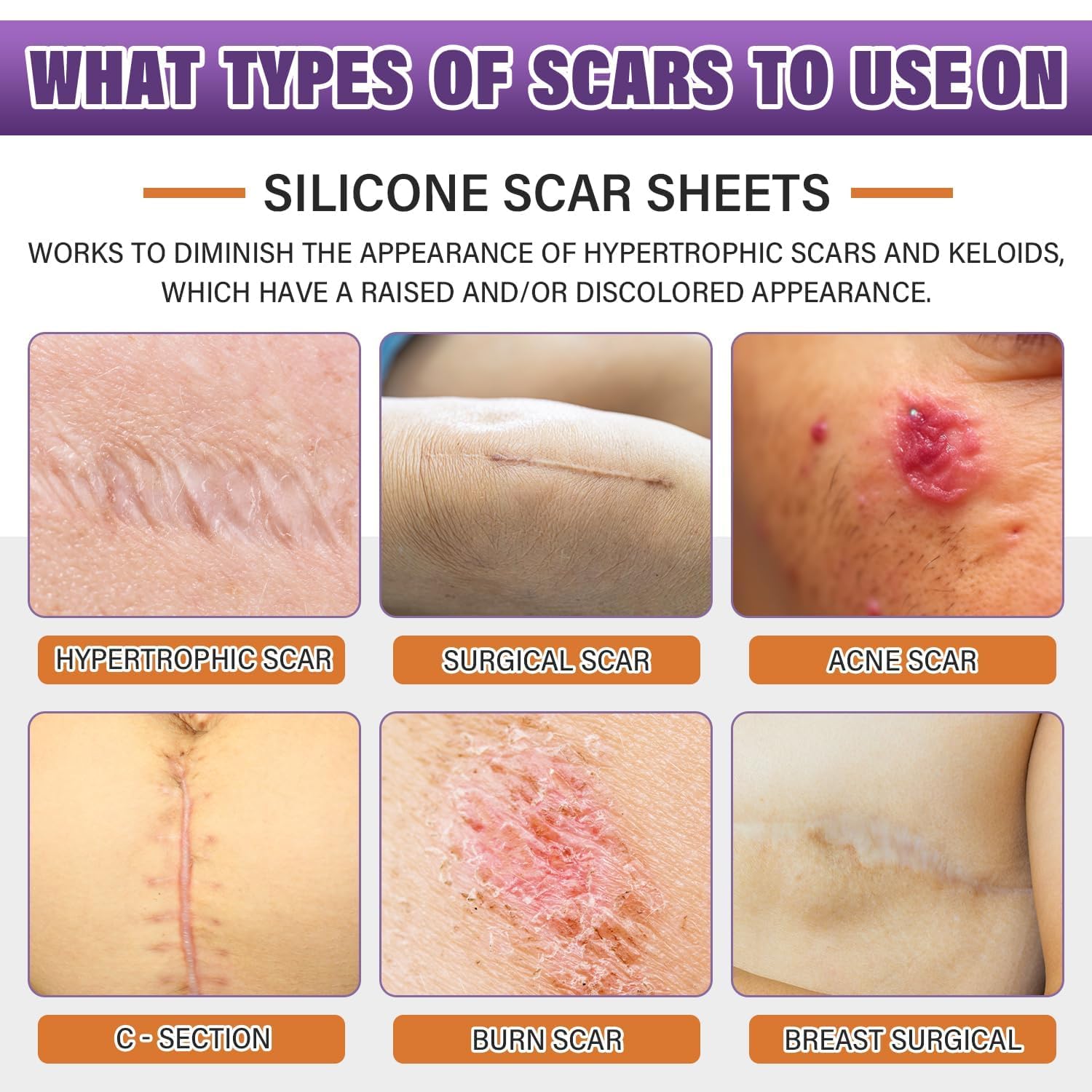 Silicone Scar Sheets